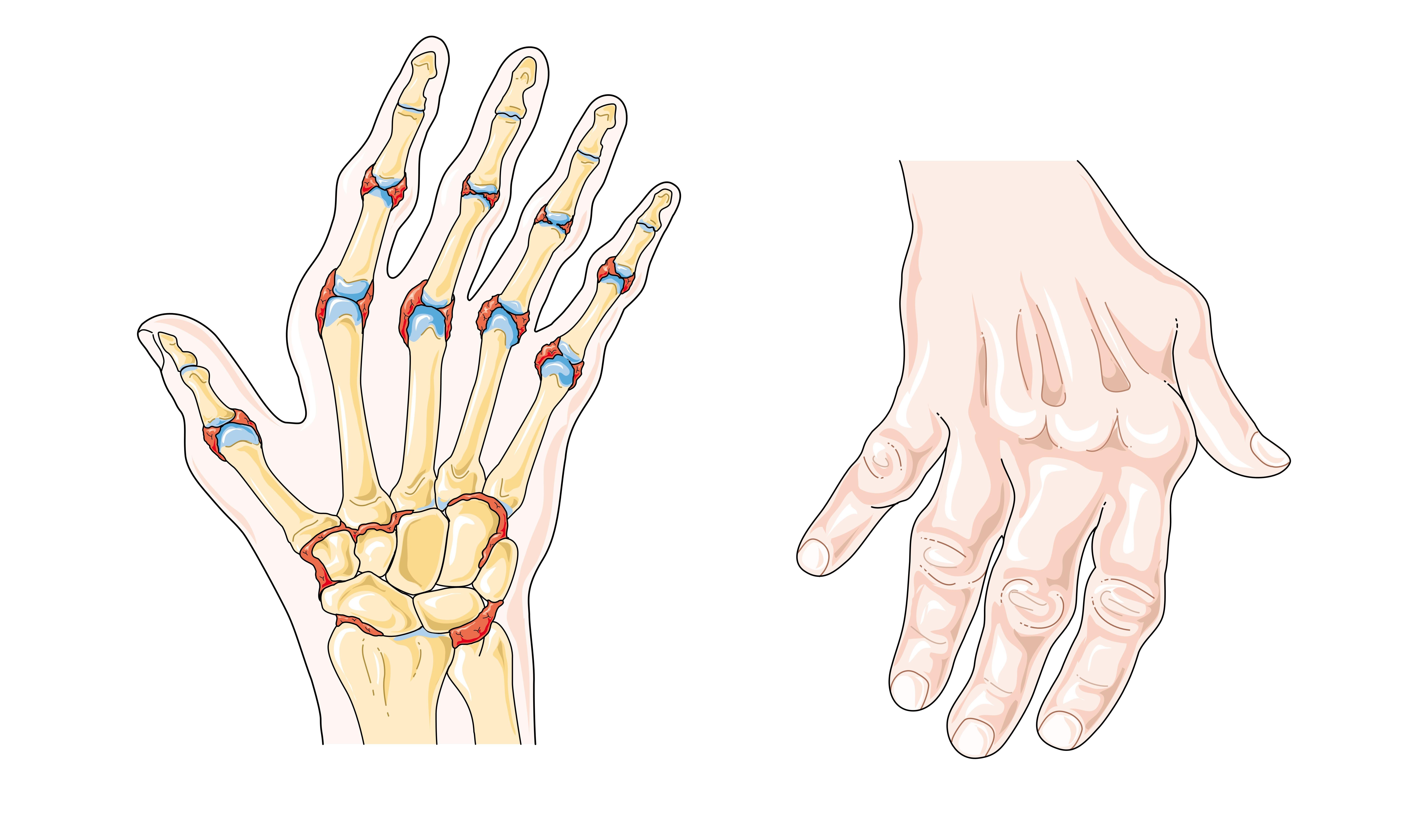 O que é artrite reumatoide