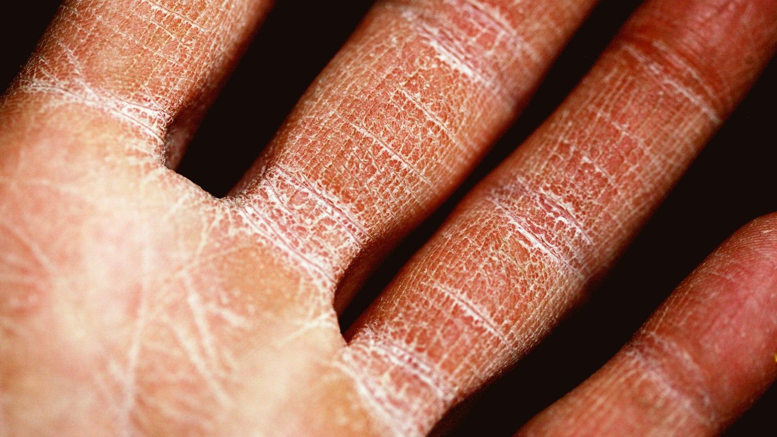 O que é eczema dishidrótico e como tratá lo